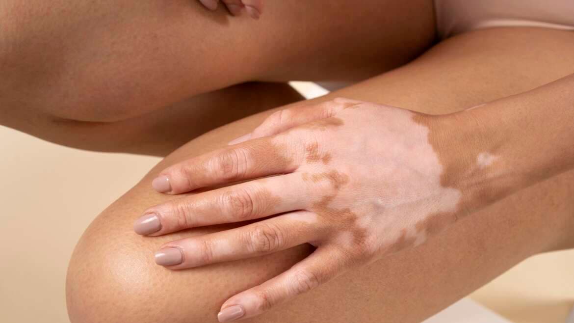 Understanding vitiligo causes, symptoms and treatment options