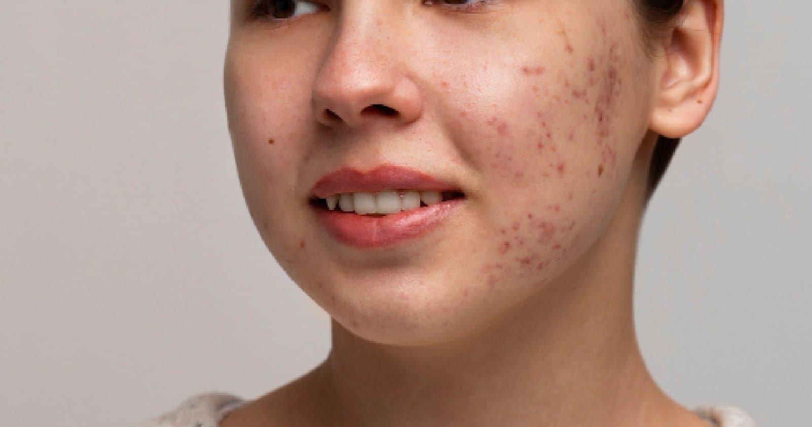Pigmentation Treatment