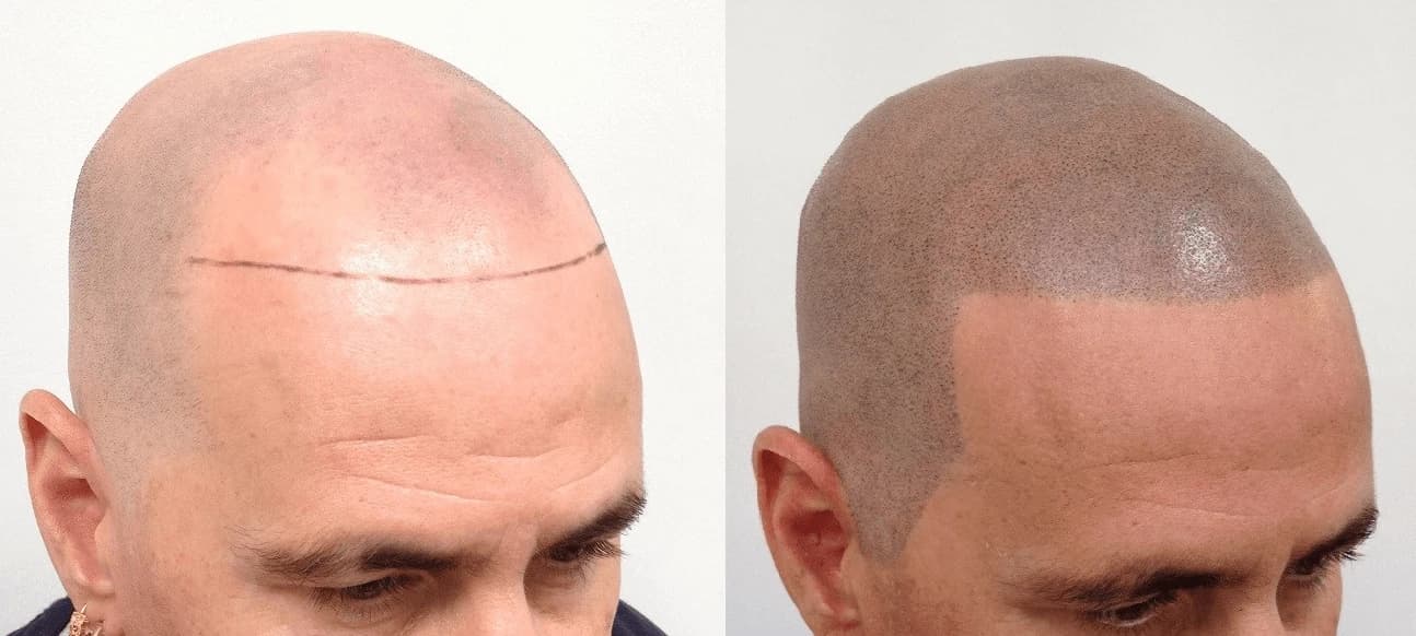 Scalp Micropigmentation