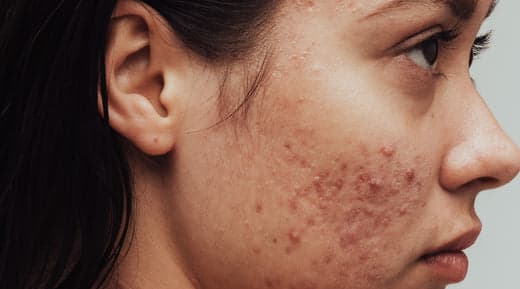 Acne (Pimples): Complete Guide by an Experienced Dermatologist
