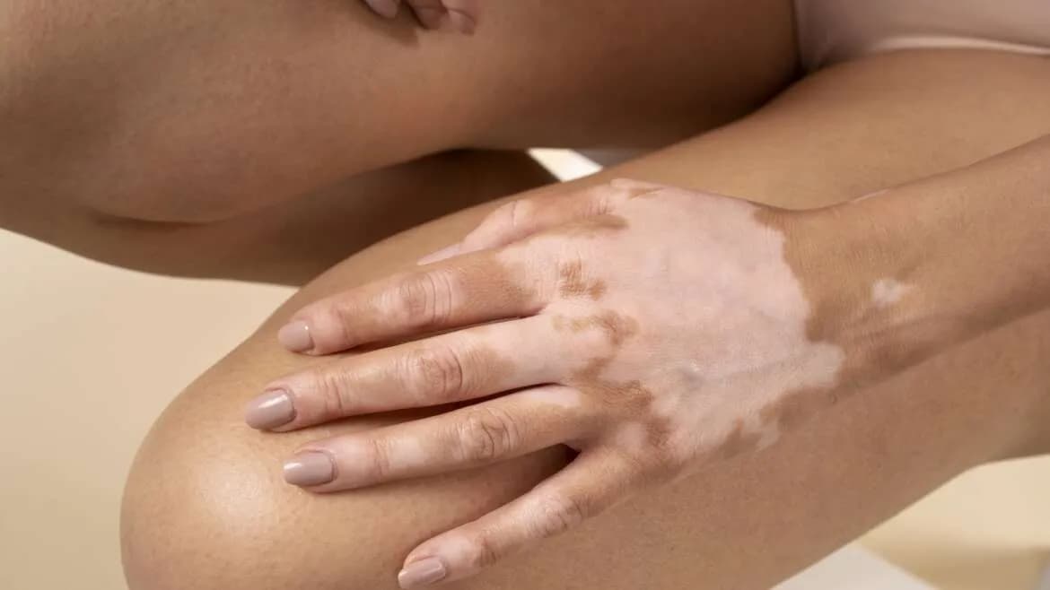 Understanding vitiligo causes, symptoms and treatment options